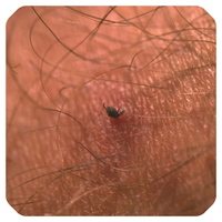 Tick Removal Tool (Quitagarrapatas)